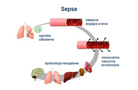 schemat procesu sepsy w organizmie ludzkim