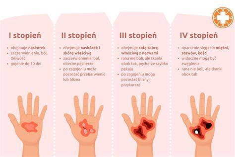 Infografika przedstawiająca stopnie oparzeń i ich rozkład na ciele dziecka