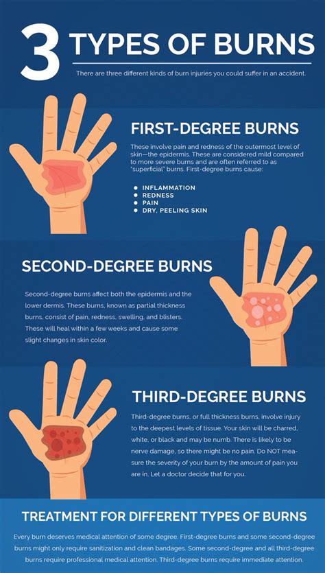 Infographics showing different degrees of burns