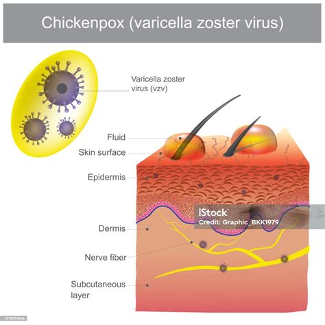 Graphic showing the spread of chickenpox