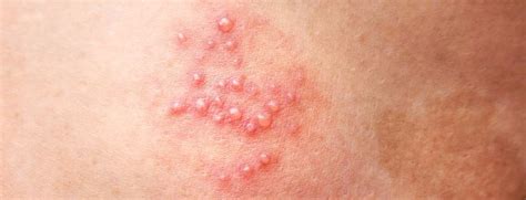 Typowe zmiany skórne w ospie wietrznej: plamki, grudki, pęcherzyki i strupki