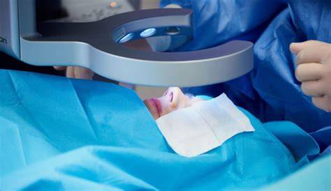 Schemat metody laserowej korekcji wzroku (np. LASIK)