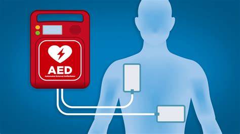 infografika wyjaśniająca działanie AED