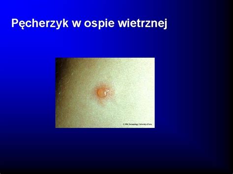 schemat ewolucji wykwitów skórnych w ospie wietrznej (plamka, grudka, pęcherzyk, krostka, strupek)