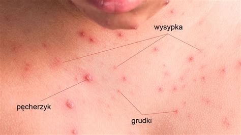 zdjęcie wysypki ospy wietrznej na skórze