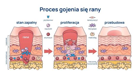 Infografika przedstawiająca typowe obrażenia po eksplozji pirotechnicznej (poparzenia, rany od odłamków), bez drastycznych scen
