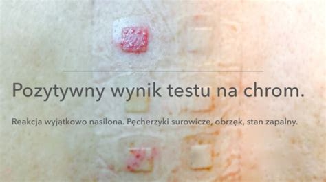 Ilustracja przedstawiająca naskórkowe testy płatkowe na skórze pleców