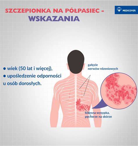 Ilustracja przedstawiająca półpasiec na tułowiu