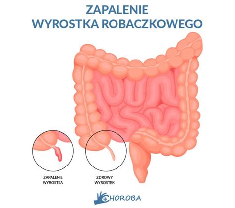 Infografika przedstawiająca objawy zapalenia wyrostka robaczkowego u dzieci