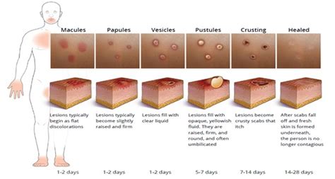 Infographic showing the stages of chickenpox rash development: papules, vesicles, pustules, scabs