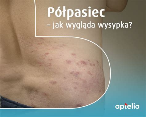 Obraz półpaśca - lokalne wykwity skórne wzdłuż przebiegu nerwu