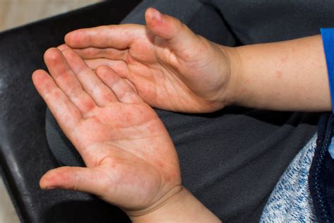 zdjęcie przedstawiające charakterystyczną wysypkę bostonki na dłoniach i stopach