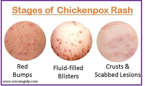 Medical infographic illustrating the stages of chickenpox rash development: macule, papule, vesicle, pustule, scab.