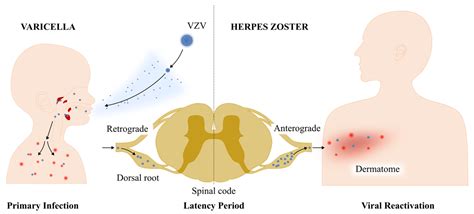 Diagram illustrating the potential effects of varicella infection at different stages of pregnancy on the fetus and newborn.