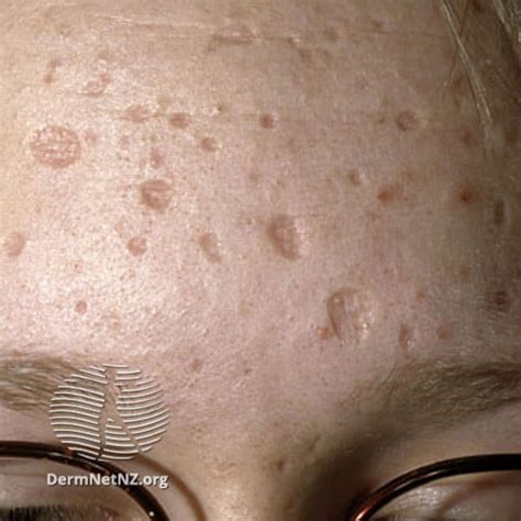 zdjęcie przedstawiające blizny po ospie wietrznej