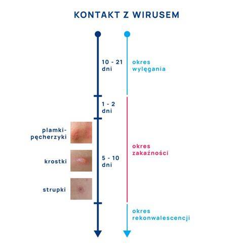 infografika przedstawiająca najczęstsze powikłania ospy wietrznej