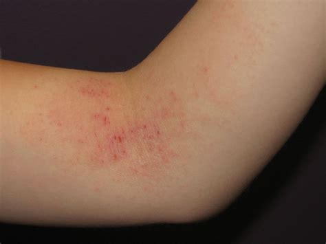Thematic photo of a child's hand with a slight rash or a general medical consultation