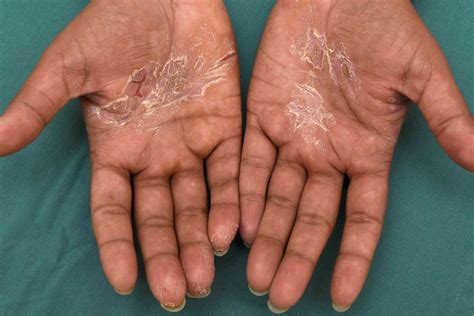 Photo of typical bostonka rash on the inner palm