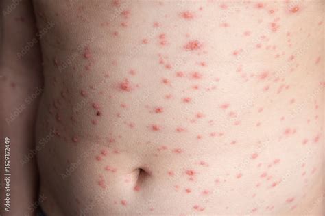 Photo of typical chickenpox rash on the back/torso