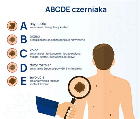 Infografika o profilaktyce czerniaka i badaniach videodermatoskopem