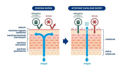 infografika: mechanizm powstawania atopowego zapalenia skóry