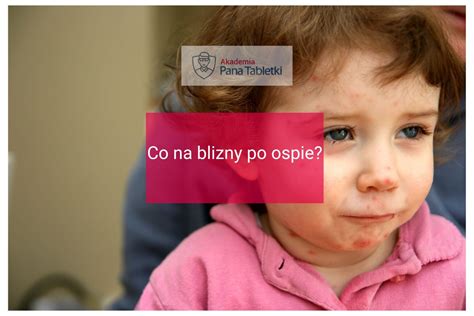 zdjęcia blizn po ospie wietrznej u dziecka