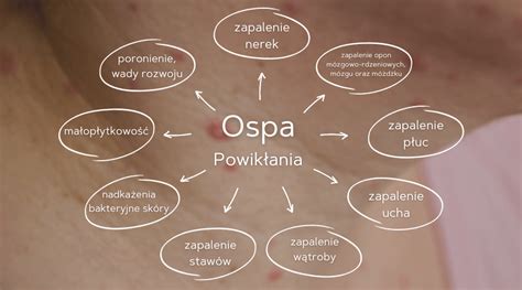 Infografika przedstawiająca najczęstsze powikłania po ospie wietrznej.