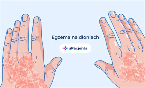 zdjęcie pokazujące dziecko z opatrunkami na rękach lub krótkimi paznokciami, by uniknąć drapania