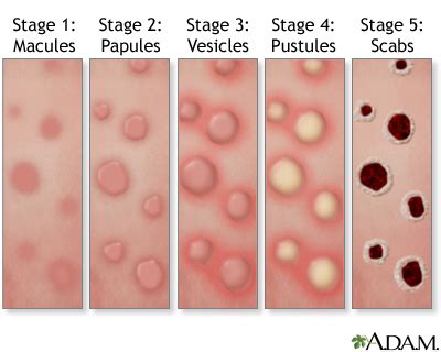 Diagram showing the stages of chickenpox rash: macule, papule, vesicle, pustule, crust.