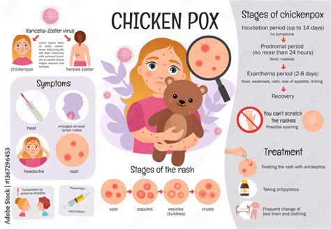 Infographic showing the stages of chickenpox rash and typical symptoms