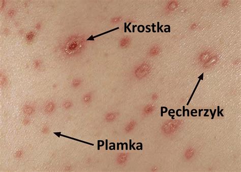 Grafika porównująca stadia wykwitów skórnych: plamka, grudka, pęcherzyk, strupek