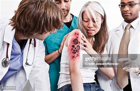 Thematic photo of a burn victim receiving medical care