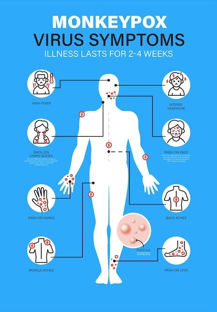 infografika: sposoby leczenia małpiej ospy