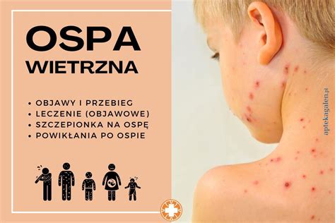 Obraz przedstawiający różne stadia wysypki ospy wietrznej