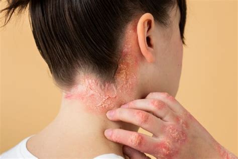 zdjęcie poglądowe skóry z różnymi problemami dermatologicznymi (trądzik, łuszczyca, łojotok)