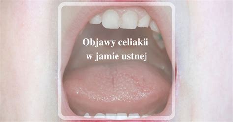 Zdjęcie przedstawiające usta dziecka z pęcherzykami ospowymi w jamie ustnej