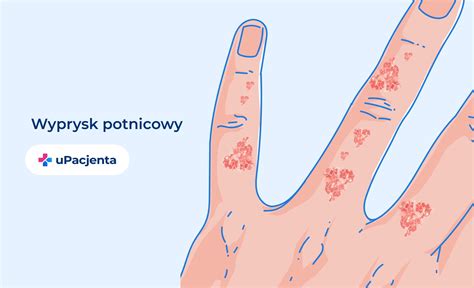 Ilustracja przedstawiająca typowe zmiany skórne w chorobie dłoni, stóp i jamy ustnej: pęcherzyki na dłoniach i stopach oraz owrzodzenia w jamie ustnej